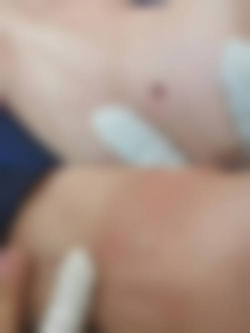 大连爱德丽格医美二氧化碳激光点痣价格40元起，精准祛痣恢复快，专业团队助你轻松拥有无瑕美肌！ 