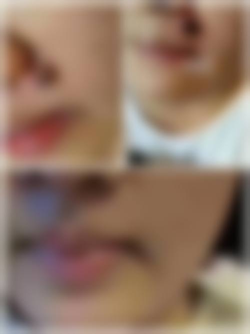 大连爱德丽格医美二氧化碳激光点痣项目的预约挂号方式