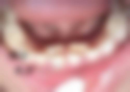 影响瘦脸针成效和注射时间的其他因素