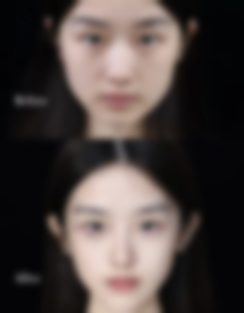 瘦脸针多久打一次成效至佳