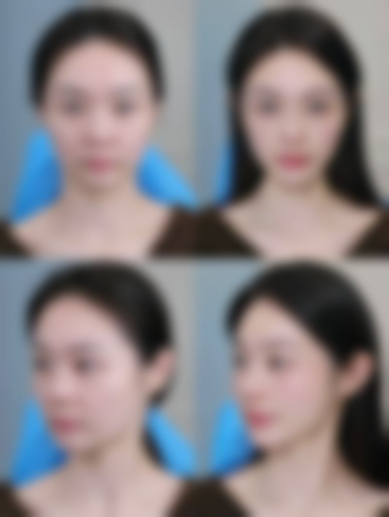 瘦脸针一般打50单位还是100单位