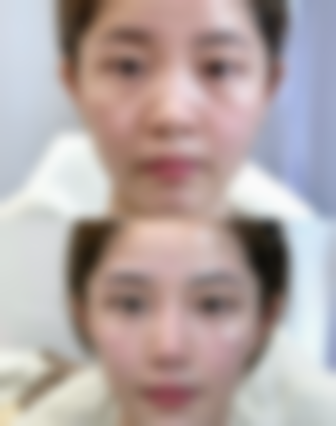 除皱针一年打几次更好