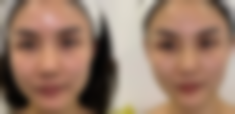 除皱针多久可以见到成效