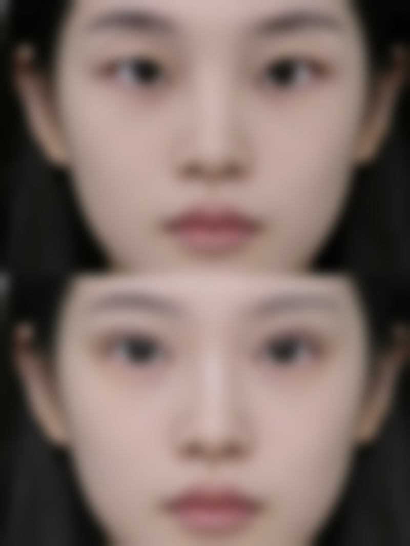 自体脂肪和玻尿酸填充太阳穴对比