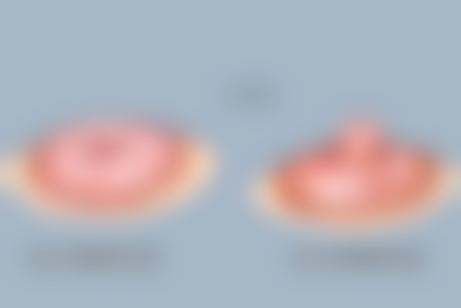 如何选择适合自己的矫正方法