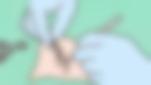 除皱针有成效吗？