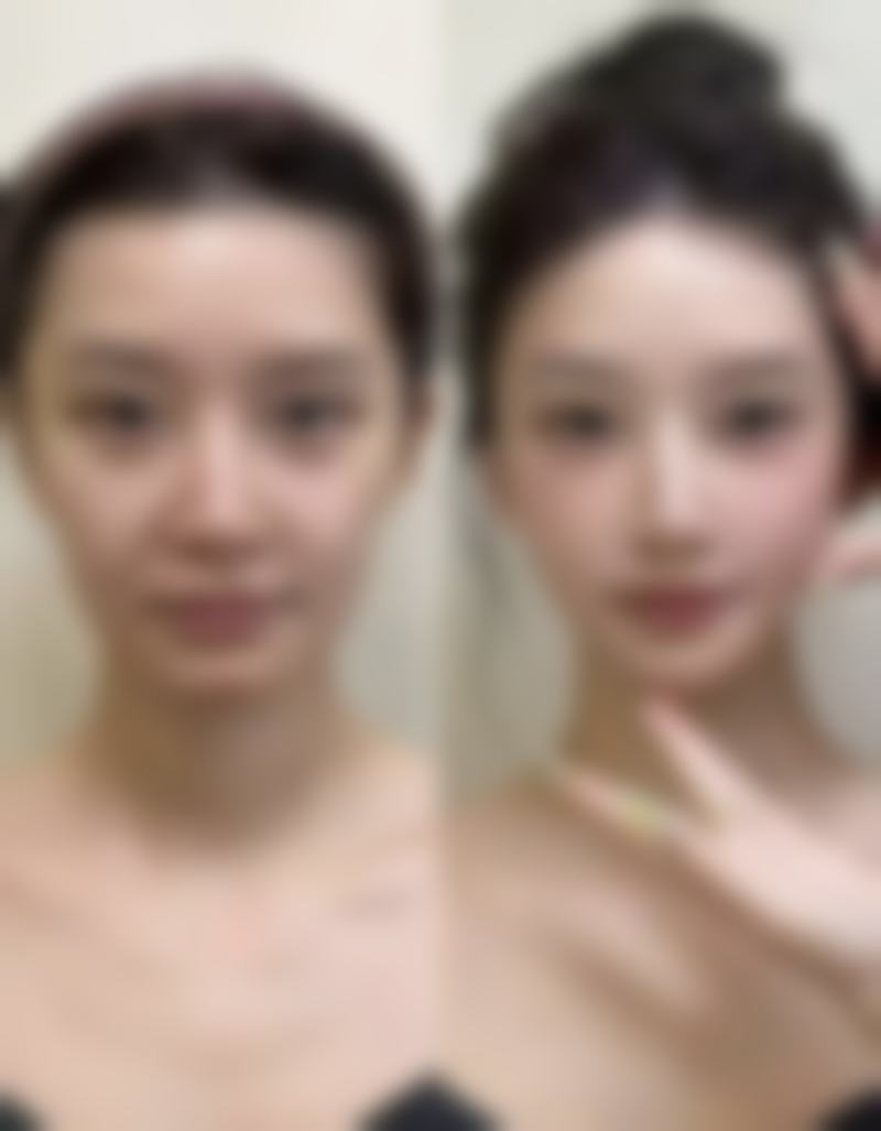 延长瘦脸针成效的方法