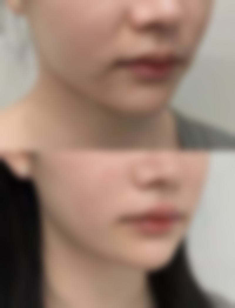 18000美白针有没有成效