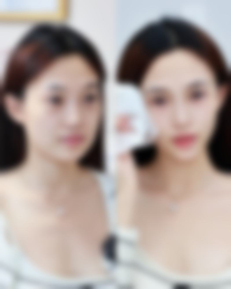 180美白针可以维持多久