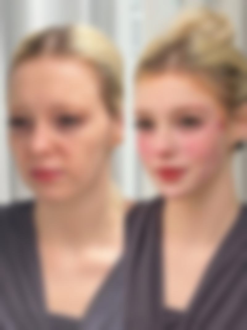 不同类型除皱针的价格及适用人群