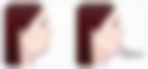 重庆打瘦脸针好去处