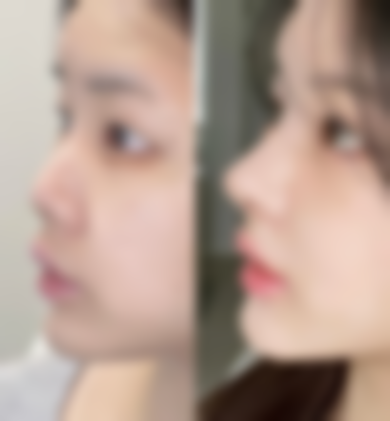 除皱针多久可以出成效