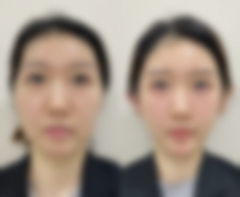 嘴唇整形对比图