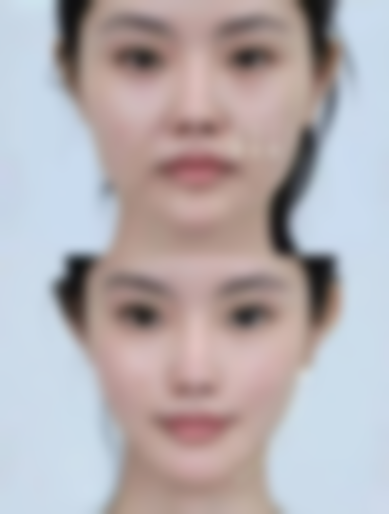 除皱针多久起成效