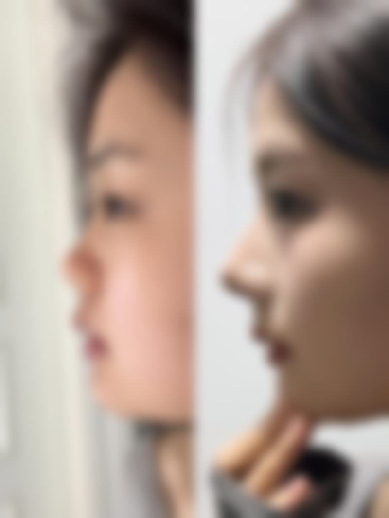 除皱针打完多久有成效