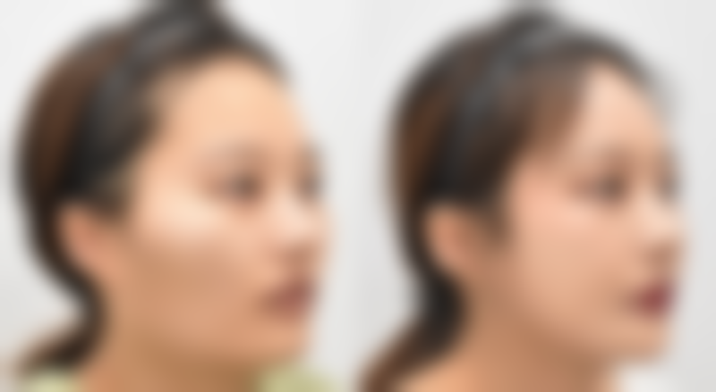 嘴唇怎么整形好看一点