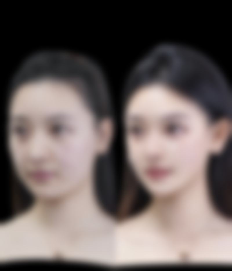 嘴唇整形修复过程