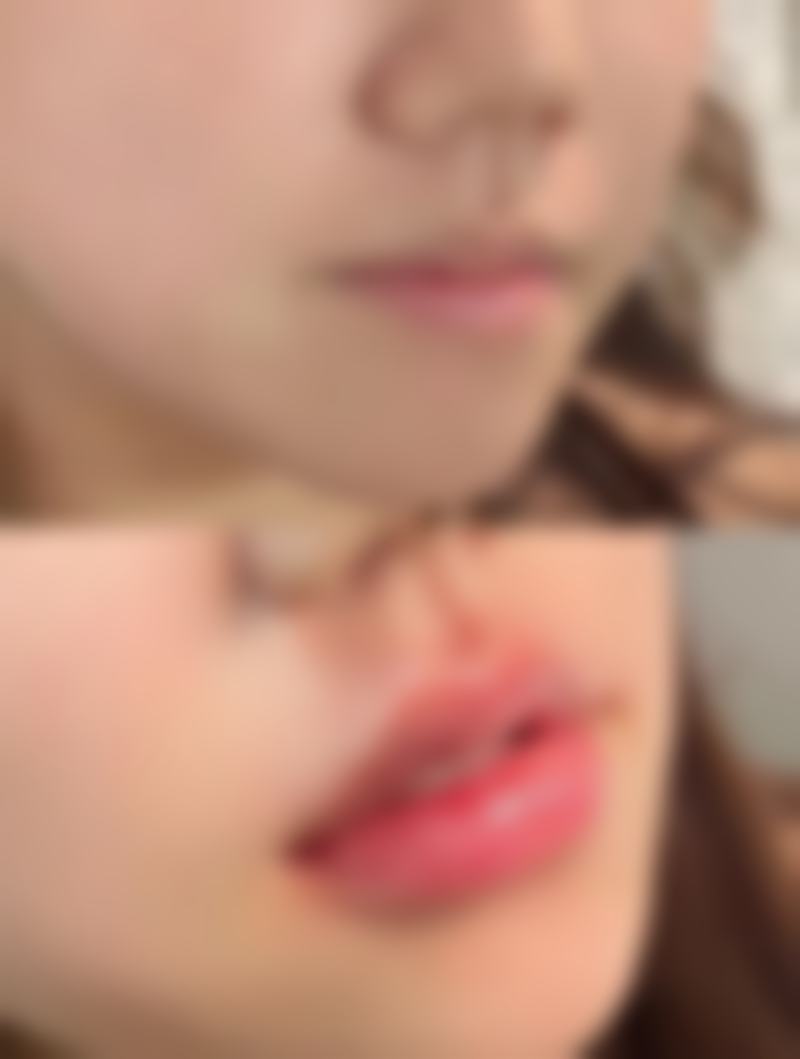 嘴巴前突怎么矫正最有效？医美揭秘4种热门方式，让你告别嘴突烦恼拥有迷人侧颜！ 