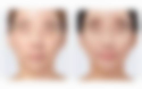 针灸除皱的原理是什么？揭秘针灸刺激穴位激活肌肤再生机制，3大关键原理让你轻松抗衰！ 