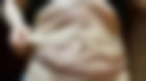 打完除皱针面部僵硬多久可以修复