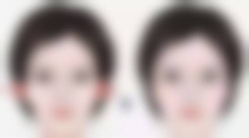 激光阴道紧缩术后遗症