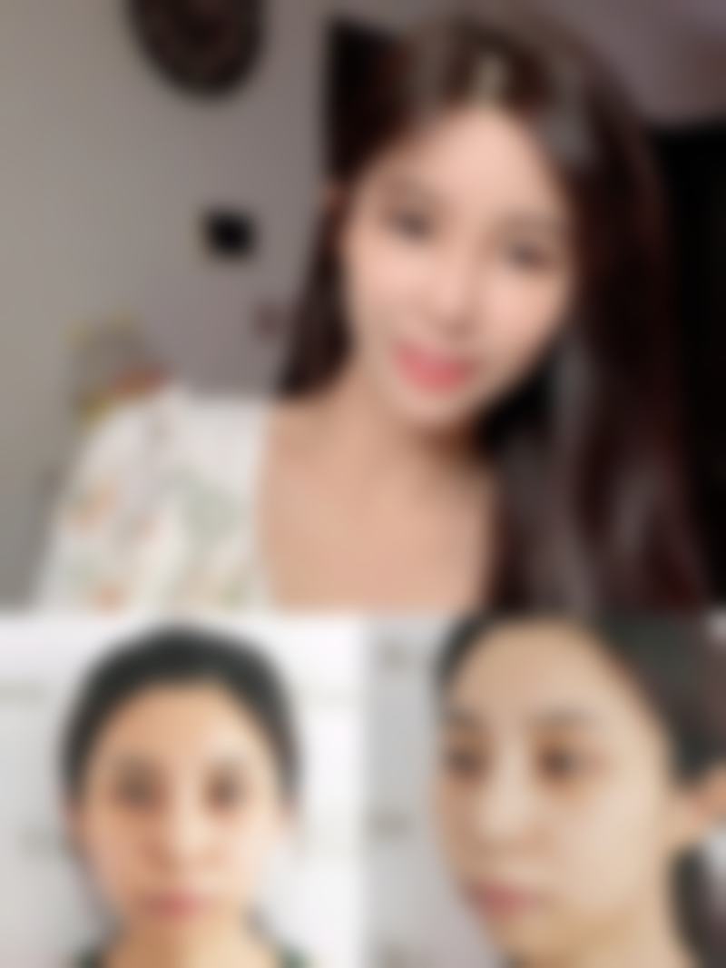 打完除皱针可以吃消炎药吗