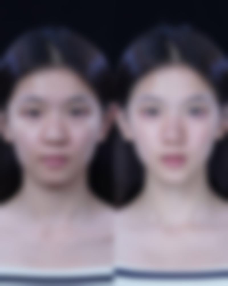 瘦脸针二十多天还会瘦吗,打瘦脸针 22 天还会小吗?