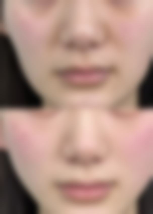 针灸除皱的原理是什么样的