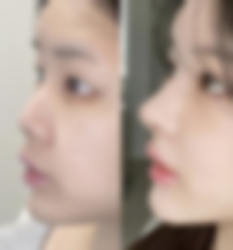 激光阴道紧缩术有效果吗？答案是肯定的！90%受术者反馈效果显著，重塑紧致提升生活质量！ 