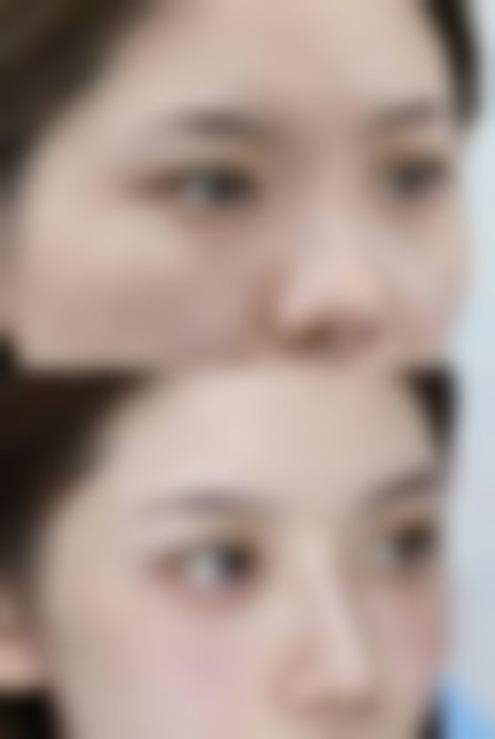 打瘦脸针需要注意什么？