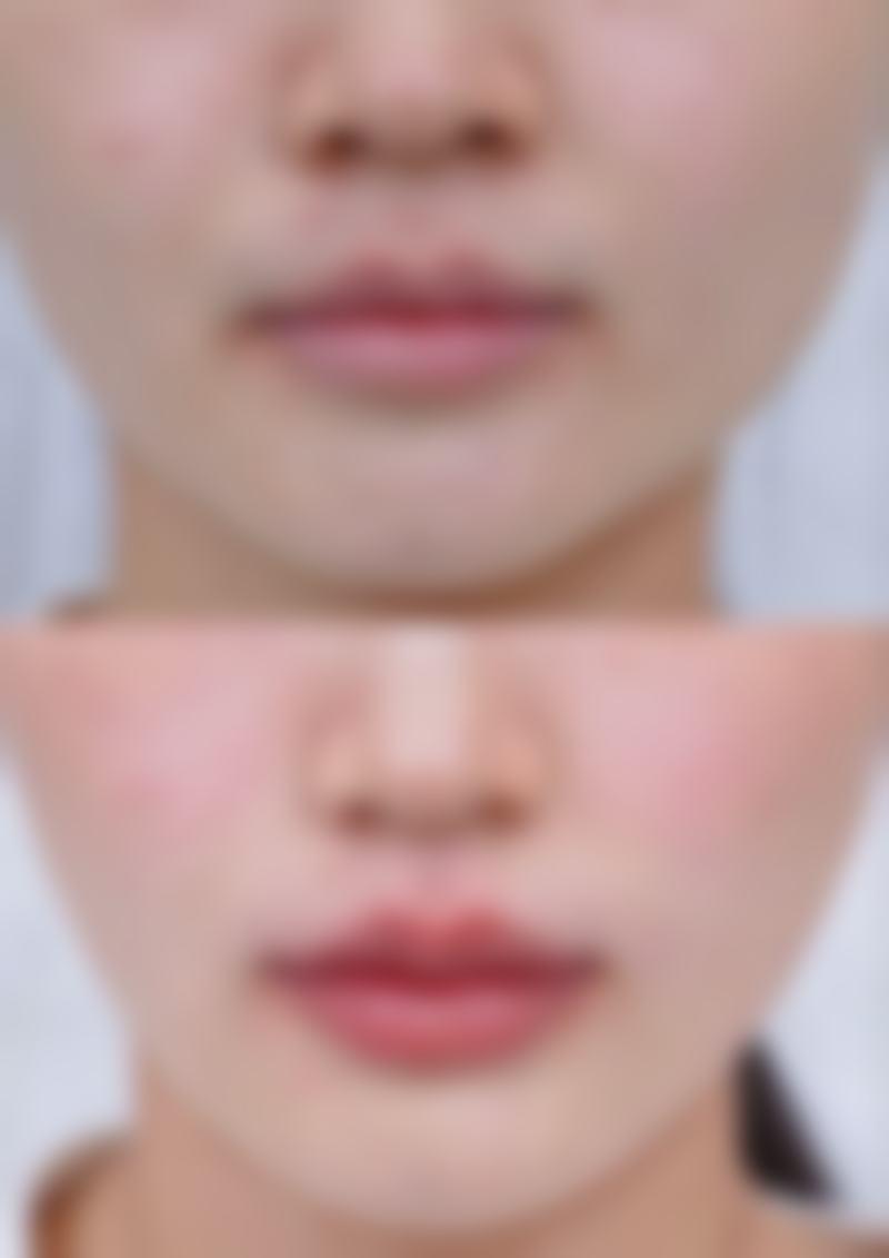 瘦脸针打三次就可以恒久定型了吗？