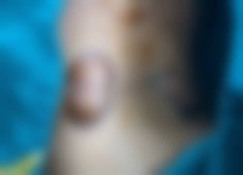 瘦脸针打几次就恒久了