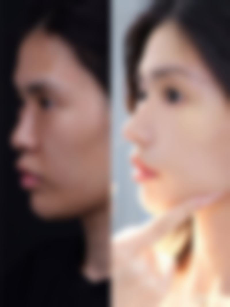 瘦脸针一个月打一次会怎样？揭秘每月一次注射，让你30天见证小脸快速蜕变的神奇效果！ 