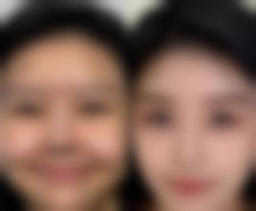 打完瘦脸针一周可以吃药吗