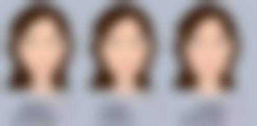 面上中1/3皮肤松弛面部除皱术式选择