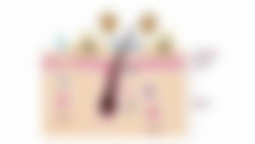 毛囊种植三种方法