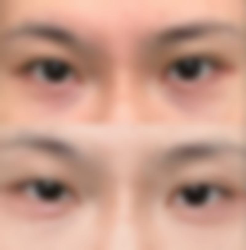 瘦脸针怎样打才有效？掌握这5大关键要点，让你轻松拥有紧致小脸，告别咬肌肥大烦恼！ 