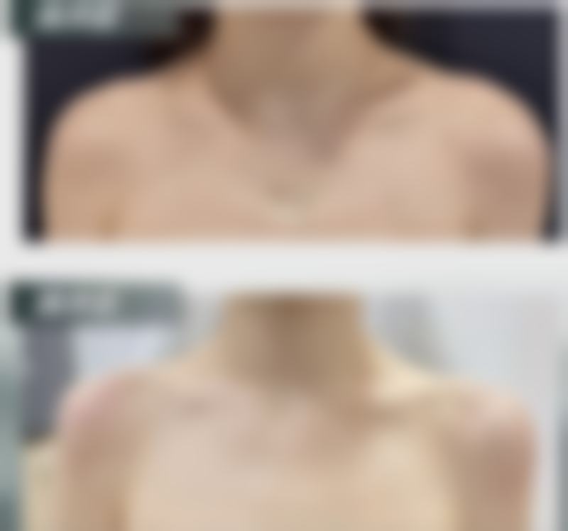 瘦脸针一般打50单位还是100单位?