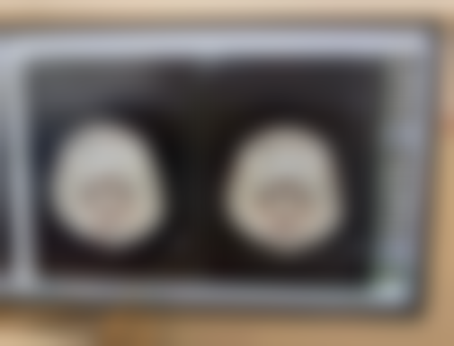 打除皱针的危害大吗？