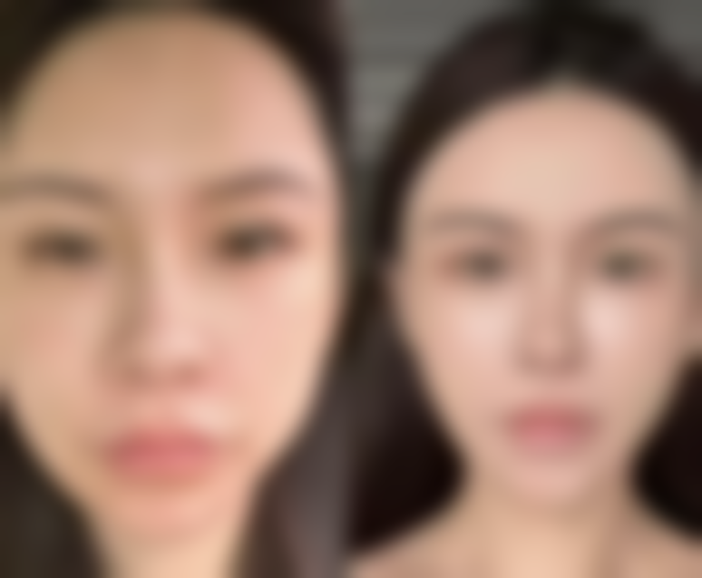 毛囊种植成效怎么样