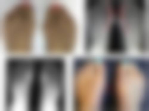 脱发青年的“头顶大事”,能“一植定终身”吗?