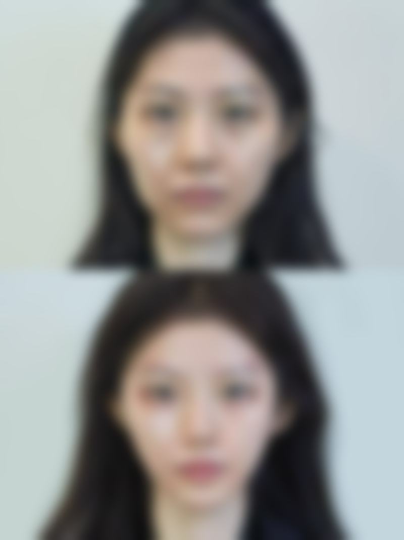 阴道紧缩手术后修复期