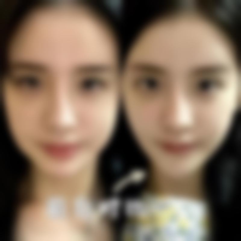 注射除皱针的教学视频