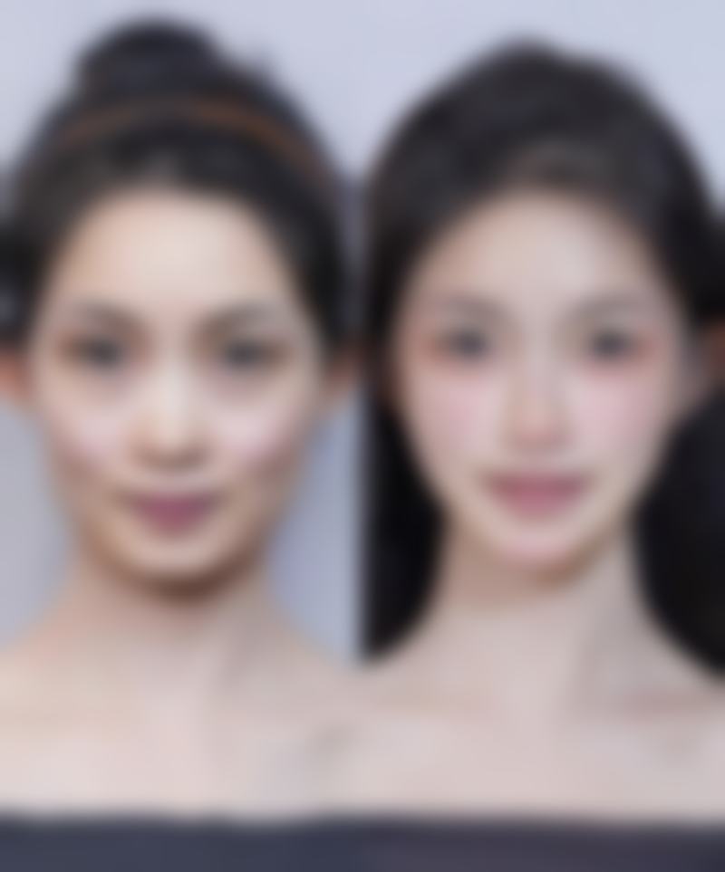 注射除皱针的成效与时间