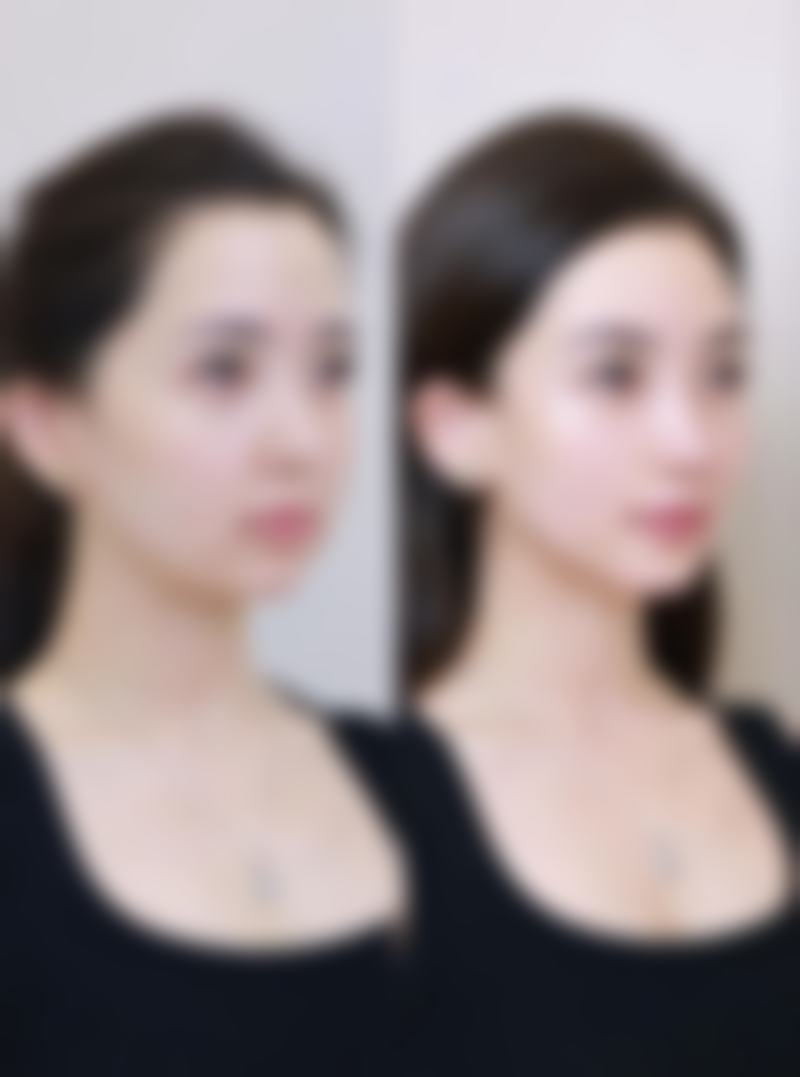 脸除皱什么成效更好