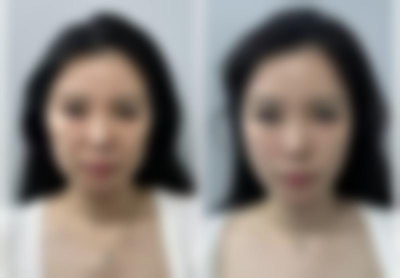 全脸除皱用什么