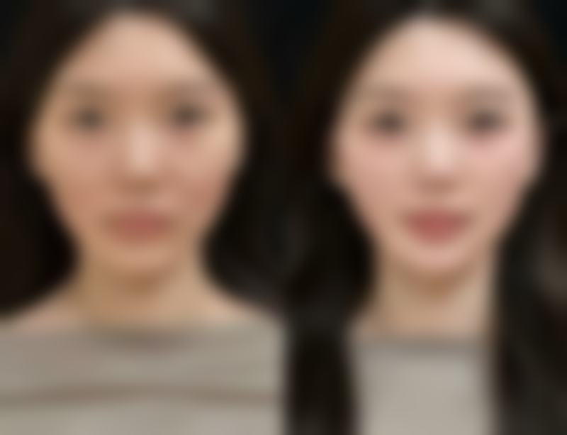 瘦脸针间隔多久打一次更好