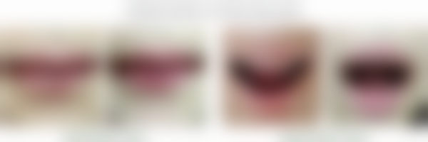 韩国思亲肤乐疤痕管理中 心配备了精良的诊疗设备。在面部轮廓整形方面，拥有高精度的三维成像设备，它可以清晰地呈现面部骨骼和软组织的结构，医生通过这些数据能够更精细地制定手术方案，提高手术的成功几率和成效。对于吸脂项目，中 心采用的是精良的吸脂设备，这种设备具有吸力均匀、创伤小的特点，能够在有效去除多余脂肪的同时，较大程度减少对周围组织的损伤，术后修复更快。在祛疤治疗中，使用的激光设备可以根据不同的疤痕类型和深度进行严谨调节，促进疤痕组织的修复和再生，达到更好的祛疤成效。