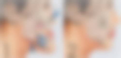 瘦脸针一边25个单位有效果吗?揭秘25单位剂量瘦脸针效果，真实案例告诉你它如何高效塑造精致小脸！ 