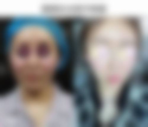 拉皮除皱的效果好吗？揭秘拉皮除皱3大显著成效，让你年轻5-10岁，效果看得见！ 